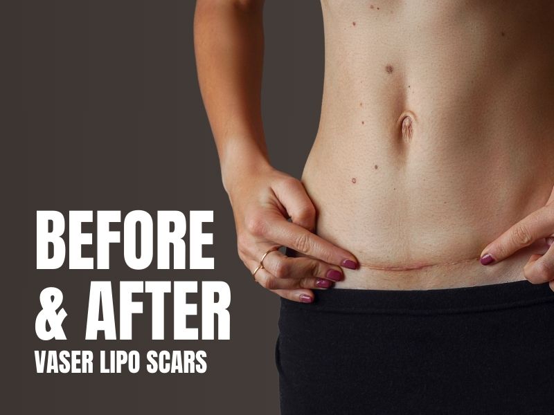 before and after vaser lipo scars