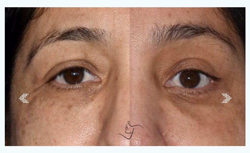 Blepharoplasty recovery time