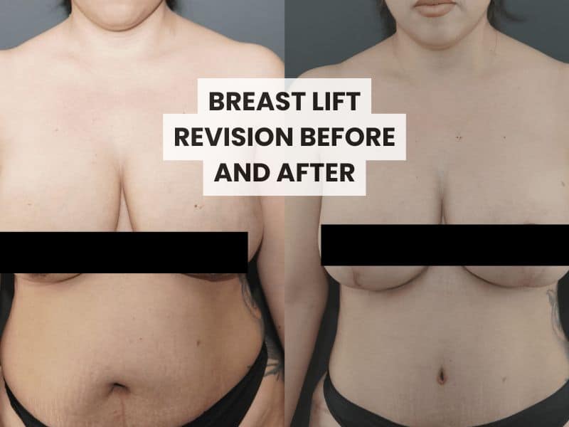 breast lift revision before and after