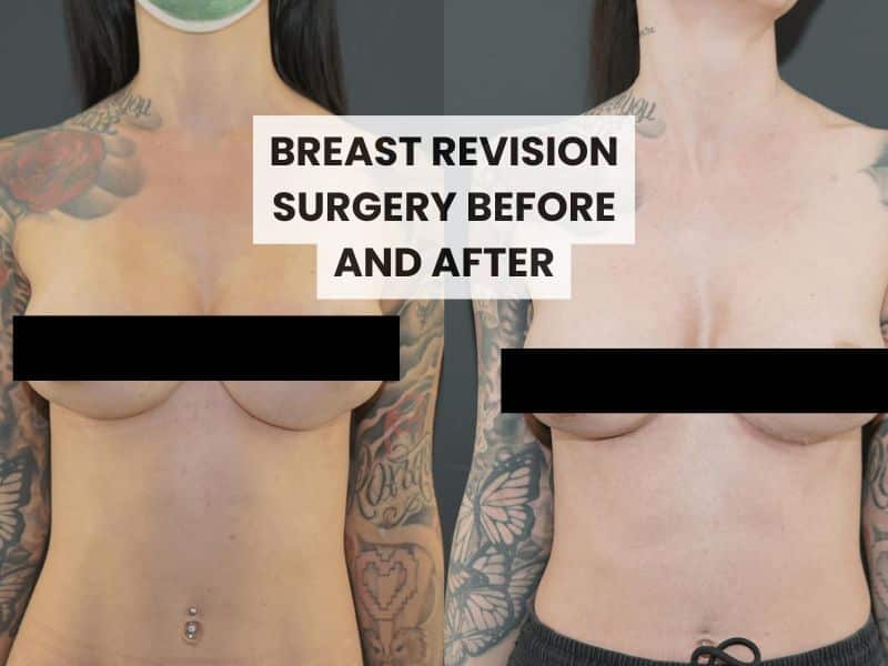 breast revision surgery before and after