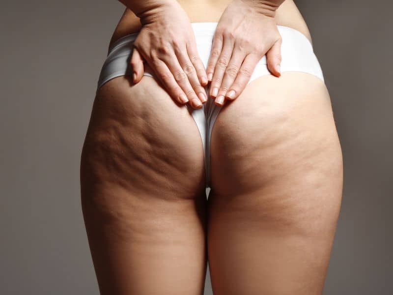 cost of aveli cellulite treatment