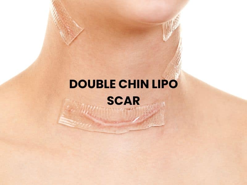 double chin lipo scar