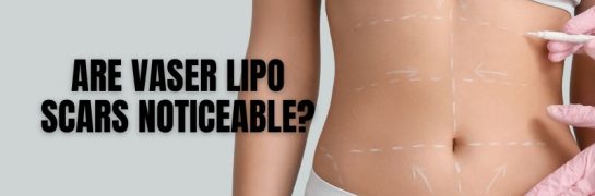 Are VASER Lipo Scars Noticeable