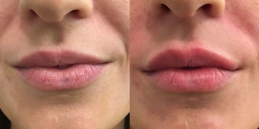 filler_06_lips