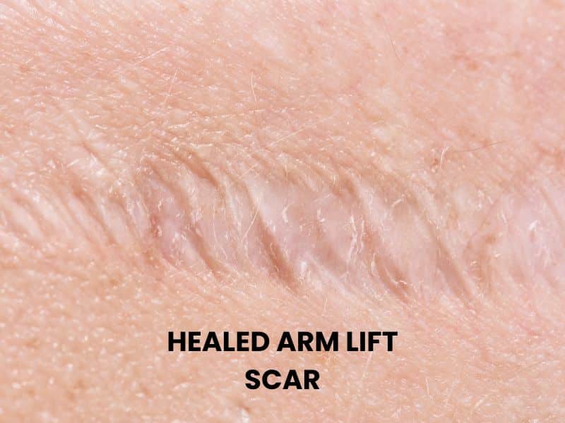 healed arm lift surgery scars