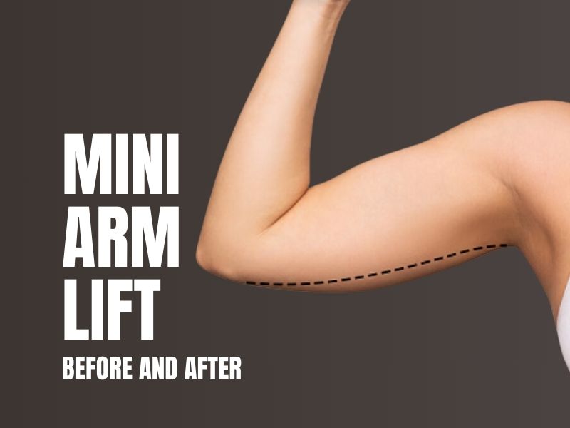 mini arm lift before and after