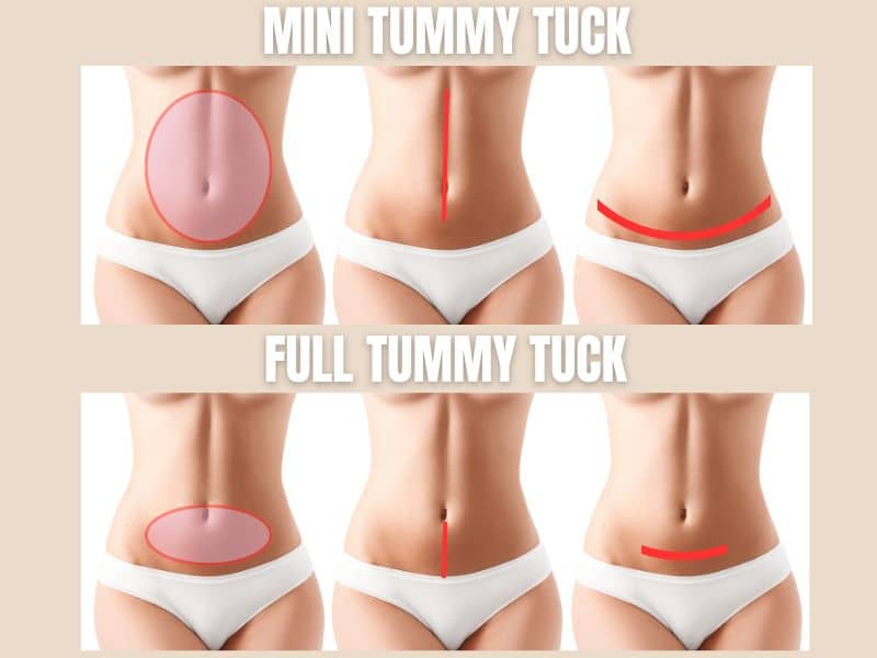 mini tummy tuck vs full