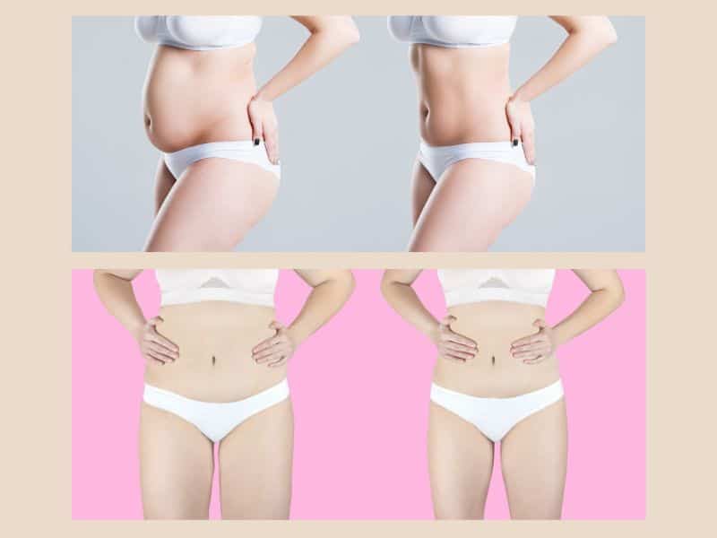 mini vs full tummy tuck