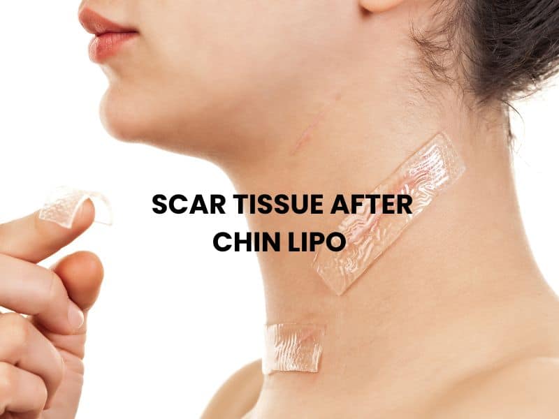 scar tissue after chin lipo