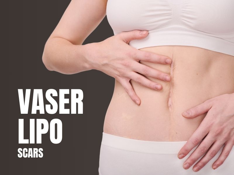 vaser lipo scars