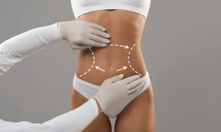 Woman patient for vaser lipo procedure